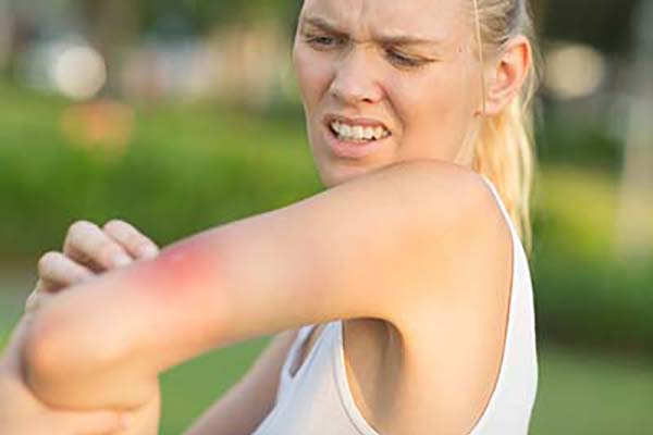 Woman with bee sting